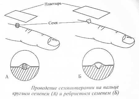 Проведение семенотерапии на пальце круглым семенем и ребристым семенем