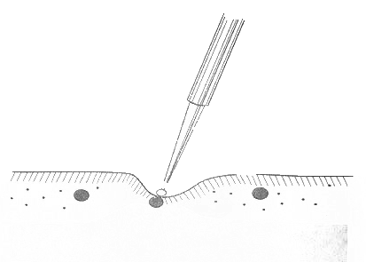 Резко болезненная точка становится точкой воздействия